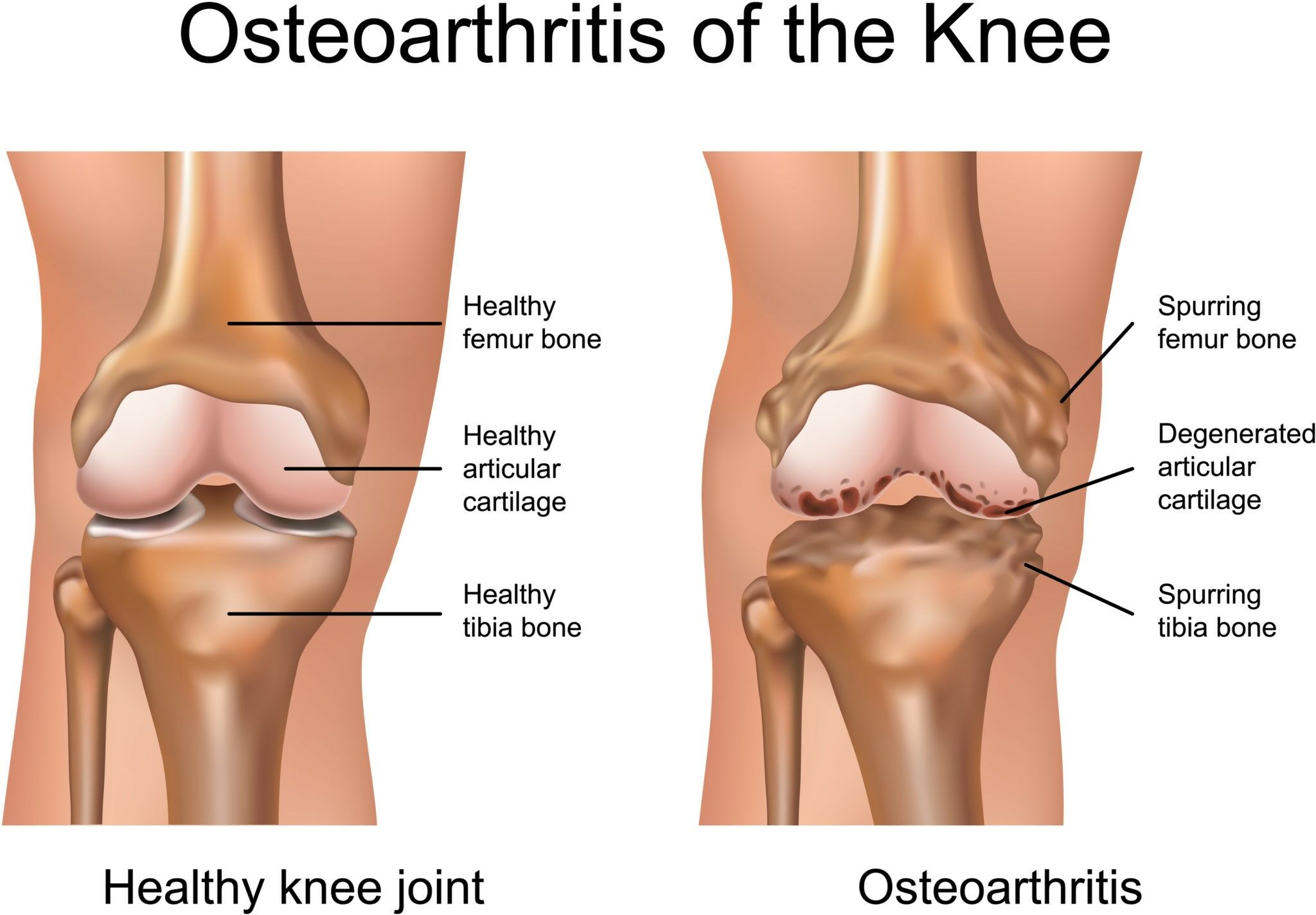 osteoarthritis fiataloknál